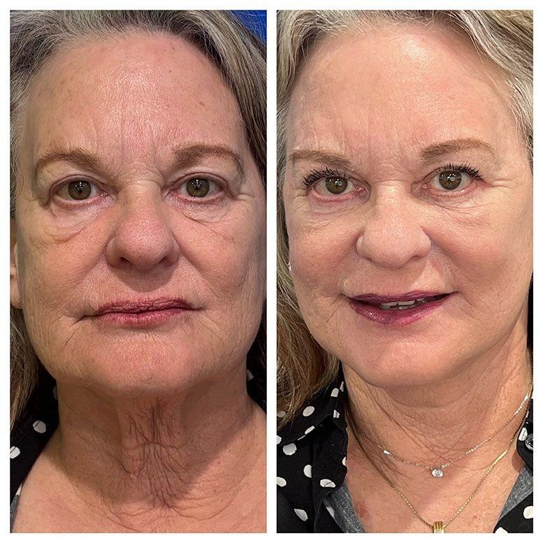Steven K Struck, MD facelift result — Atherton, CA