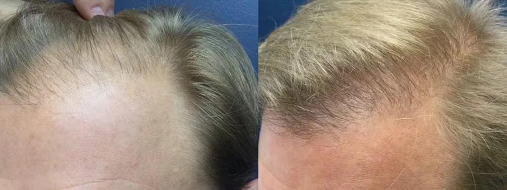 Morgenstern Hair Restoration hair restoration result — Bala Cynwyd, PA