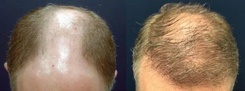 Morgenstern Hair Restoration hair restoration result — Bala Cynwyd, PA