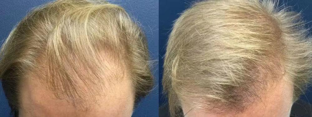 Morgenstern Hair Restoration hair restoration result — Bala Cynwyd, PA