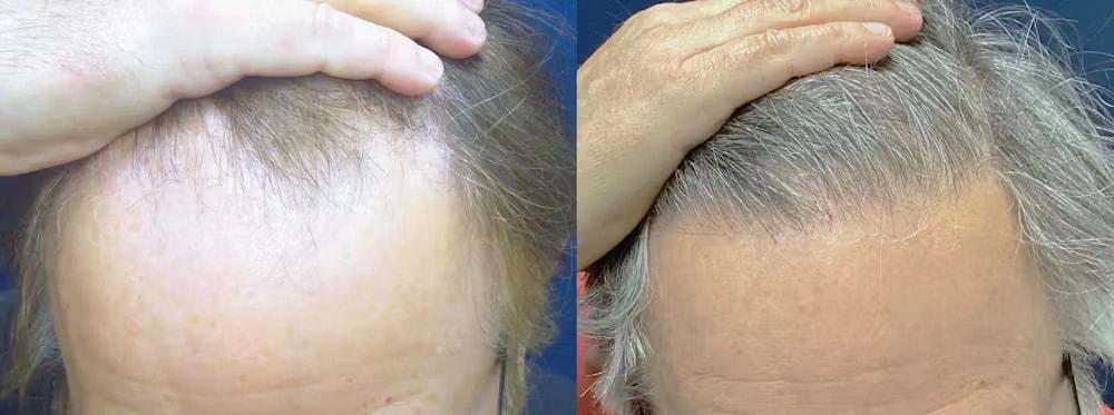 Morgenstern Hair Restoration hair restoration result — Bala Cynwyd, PA