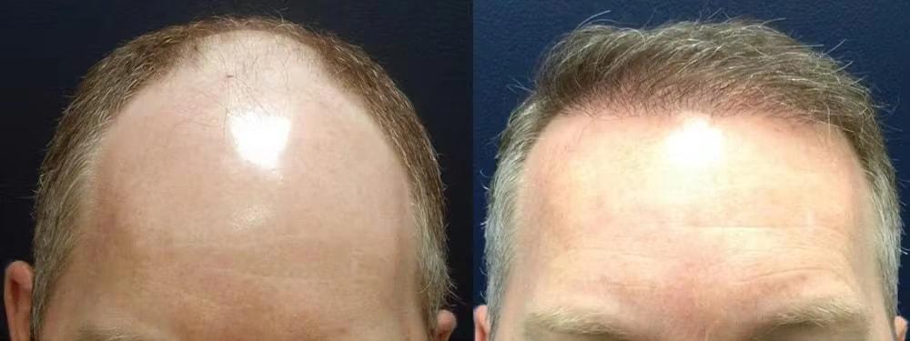 Morgenstern Hair Restoration hair restoration result — Bala Cynwyd, PA