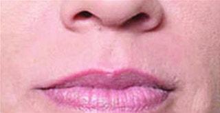 Kleinman Plastic Surgery lip filler after — Harrison, NY