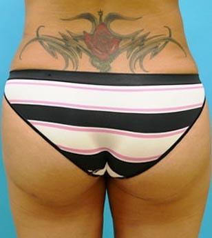Kleinman Plastic Surgery liposuction after — Harrison, NY
