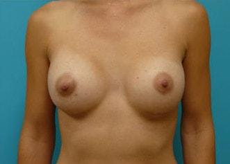 Kleinman Plastic Surgery breast augmentation after — Harrison, NY