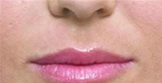 Kleinman Plastic Surgery lip filler after — Harrison, NY