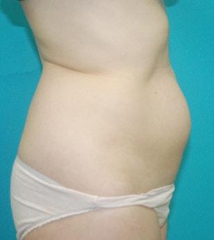 Kleinman Plastic Surgery liposuction after — Harrison, NY