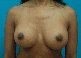 Kleinman Plastic Surgery breast augmentation after — Harrison, NY