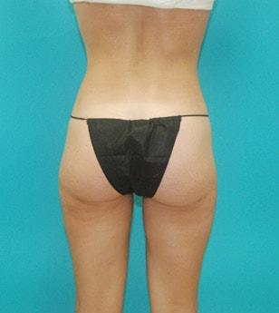 Kleinman Plastic Surgery liposuction after — Harrison, NY