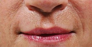 Kleinman Plastic Surgery lip filler after — Harrison, NY