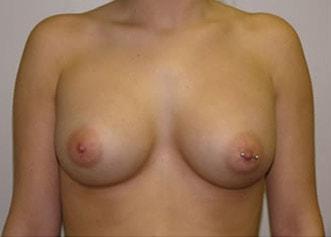 Kleinman Plastic Surgery breast augmentation after — Harrison, NY