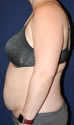 Liposuction before at Tanasbourne Plastic Surgery: Cober Sheldon R MD in Portland, OR