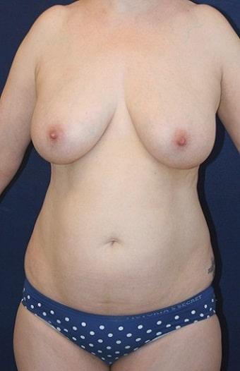 Liposuction before at Tanasbourne Plastic Surgery: Cober Sheldon R MD in Portland, OR