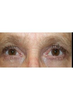 Brow Lift after at Tanasbourne Plastic Surgery: Cober Sheldon R MD in Portland, OR