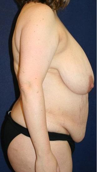 Tummy Tuck before at Tanasbourne Plastic Surgery: Cober Sheldon R MD in Portland, OR