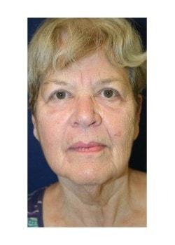 Facelift before at Tanasbourne Plastic Surgery: Cober Sheldon R MD in Portland, OR