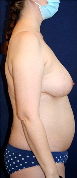 Liposuction before at Tanasbourne Plastic Surgery: Cober Sheldon R MD in Portland, OR