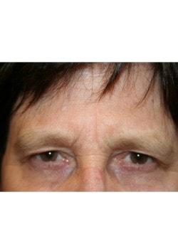 Brow Lift before at Tanasbourne Plastic Surgery: Cober Sheldon R MD in Portland, OR