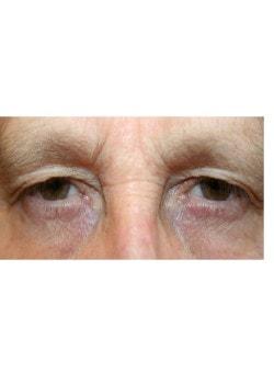 Brow Lift before at Tanasbourne Plastic Surgery: Cober Sheldon R MD in Portland, OR
