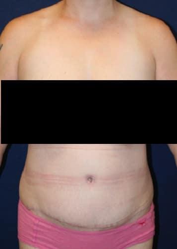 Liposuction after at Tanasbourne Plastic Surgery: Cober Sheldon R MD in Portland, OR