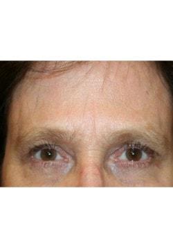 Tanasbourne Plastic Surgery: Cober Sheldon R MD brow lift after — Portland, OR