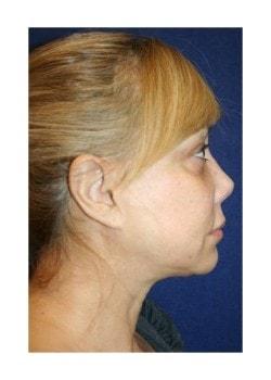 Facelift before at Tanasbourne Plastic Surgery: Cober Sheldon R MD in Portland, OR