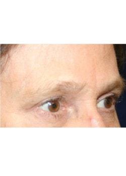 Tanasbourne Plastic Surgery: Cober Sheldon R MD brow lift after — Portland, OR