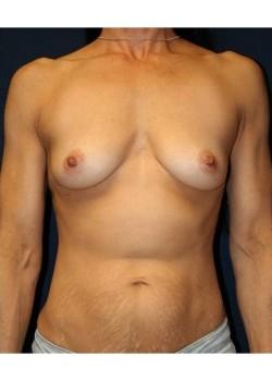 Mommy Makeover before at Tanasbourne Plastic Surgery: Cober Sheldon R MD in Portland, OR