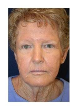Facelift before at Tanasbourne Plastic Surgery: Cober Sheldon R MD in Portland, OR
