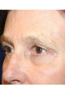 Tanasbourne Plastic Surgery: Cober Sheldon R MD brow lift after — Portland, OR