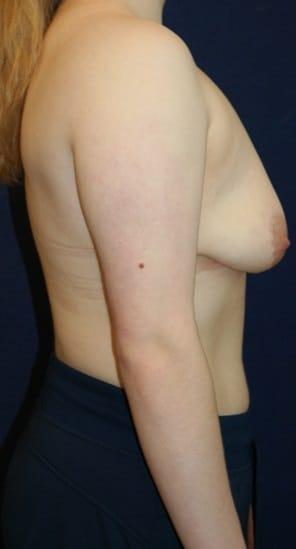 Breast Lift before at Tanasbourne Plastic Surgery: Cober Sheldon R MD in Portland, OR