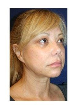 Facelift before at Tanasbourne Plastic Surgery: Cober Sheldon R MD in Portland, OR