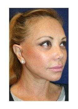 Tanasbourne Plastic Surgery: Cober Sheldon R MD facelift after — Portland, OR