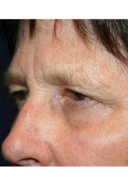 Brow Lift before at Tanasbourne Plastic Surgery: Cober Sheldon R MD in Portland, OR