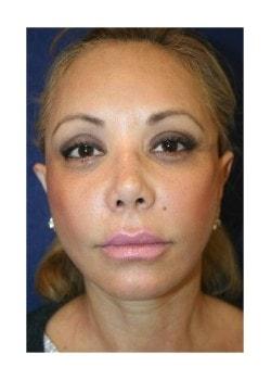 Facelift after at Tanasbourne Plastic Surgery: Cober Sheldon R MD in Portland, OR