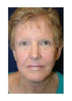 Tanasbourne Plastic Surgery: Cober Sheldon R MD facelift after — Portland, OR