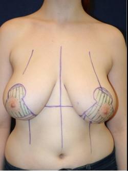 Breast Reduction before at Tanasbourne Plastic Surgery: Cober Sheldon R MD in Portland, OR
