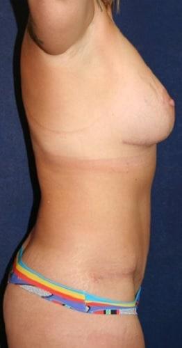 Breast Lift after at Tanasbourne Plastic Surgery: Cober Sheldon R MD in Portland, OR