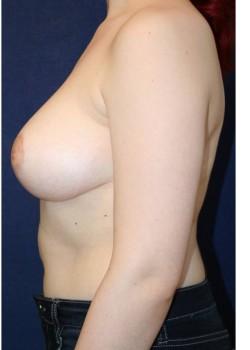 Breast Reduction after at Tanasbourne Plastic Surgery: Cober Sheldon R MD in Portland, OR