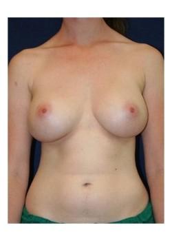 Mommy Makeover after at Tanasbourne Plastic Surgery: Cober Sheldon R MD in Portland, OR