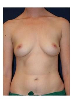 Mommy Makeover before at Tanasbourne Plastic Surgery: Cober Sheldon R MD in Portland, OR