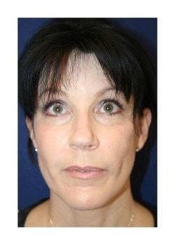 Facelift after at Tanasbourne Plastic Surgery: Cober Sheldon R MD in Portland, OR