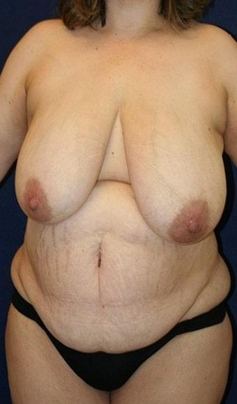 Tummy Tuck before at Tanasbourne Plastic Surgery: Cober Sheldon R MD in Portland, OR