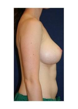Tanasbourne Plastic Surgery: Cober Sheldon R MD breast augmentation after — Portland, OR
