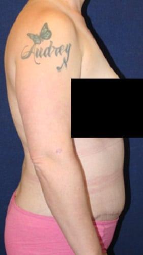 Liposuction after at Tanasbourne Plastic Surgery: Cober Sheldon R MD in Portland, OR