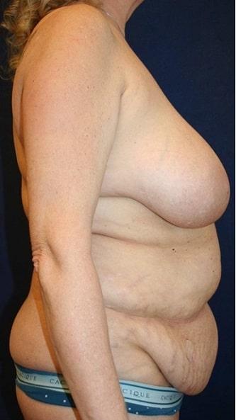 Tummy Tuck before at Tanasbourne Plastic Surgery: Cober Sheldon R MD in Portland, OR