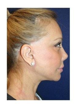 Tanasbourne Plastic Surgery: Cober Sheldon R MD facelift after — Portland, OR