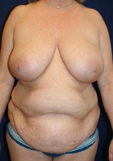Tummy Tuck before at Tanasbourne Plastic Surgery: Cober Sheldon R MD in Portland, OR