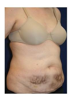 Liposuction before at Tanasbourne Plastic Surgery: Cober Sheldon R MD in Portland, OR