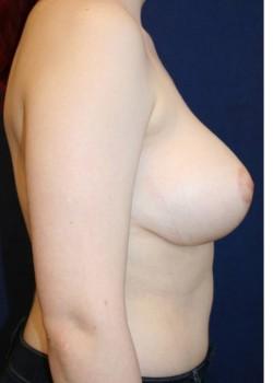 Breast Reduction after at Tanasbourne Plastic Surgery: Cober Sheldon R MD in Portland, OR
